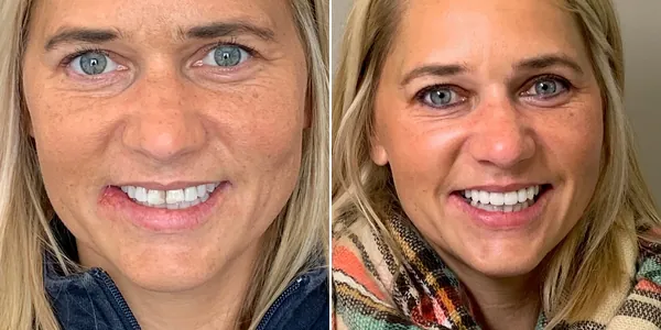 Before and after: a whiter, more confident smile
