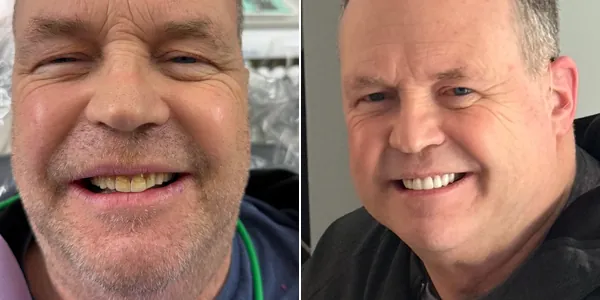 Before and after: yellowed teeth brightened to a cleaner, whiter smile