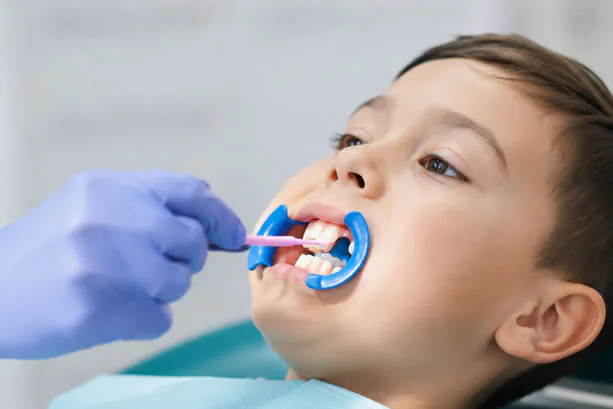 Dental sealants applied to teeth at Family Dentistry of Loveland