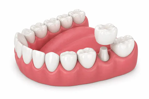 Porcelain crown restoration at Family Dentistry of Loveland